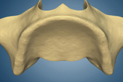 Maxillary Atrophy after Tooth Extraction-Occlusal view